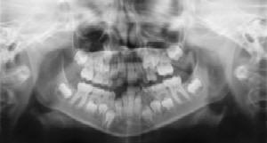 Dental Radiographs (X-Rays) - Pediatric Dentist in Mansfield, Tx