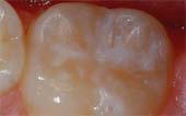 Sealant-After - Pediatric Dentist in Mansfield, Tx